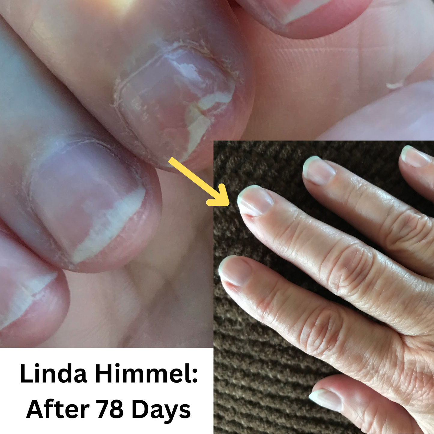 FlexiNail Nail Conditioning and Cuticle Treatment Package for Peeling, Weak, Brittle & Splitting Nails | Natural Nail Repair & Growth