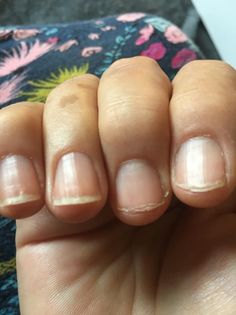 How to Repair Peeling Nails: Complete Treatment Guide for 2026
