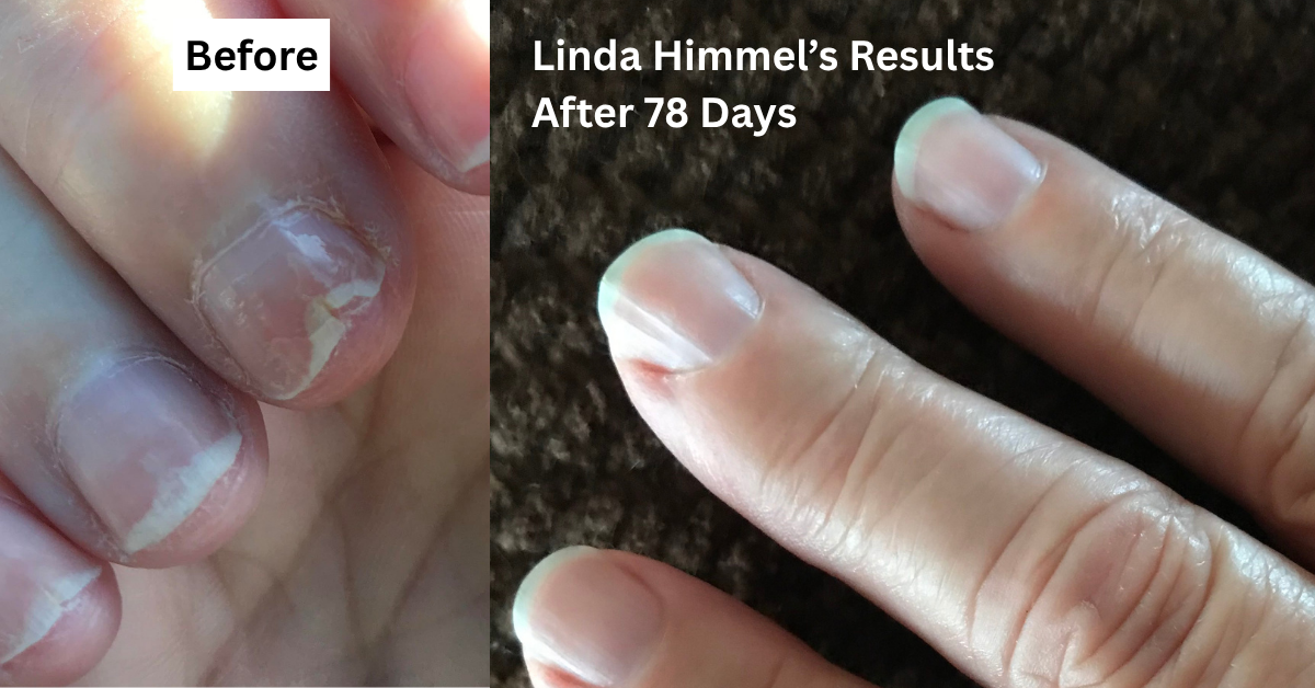 Linda Himmel before and after 78 days of FlexiNail use